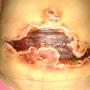 Cicatrización Abdominal