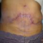 Cicatrización Abdominal