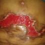 Cicatrización Abdominal