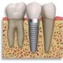 Implantes dentales