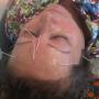 Acupuntura Cosmetica (Anti - Arrugas)
