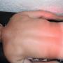 Tratamiento para dolor Cervical y Lumbago