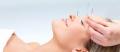 Acupuntura Estética Facial (anti - arrugas)
