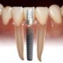 Implantes dentales en Bogota