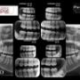 Coronal