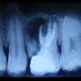 Periapical