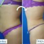 Abdominoplastia (tummy tuck)