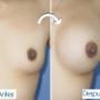 Cirugía de Aumento de Mamas (Mamoplastia)
