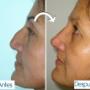 Cirugía de la nariz (rinoplastia)