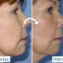 Cirugía del estiramiento facial (ritidoplastia)