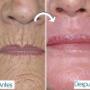 Dermoabrasión facial (peeling)
