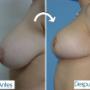 Mamoplastia de Reducción