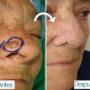 Reconstruccion Nasal