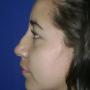 Rinoplastia antes A