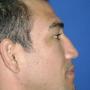 Rinoplastia antes B