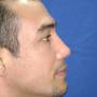 Rinoplastia después B
