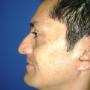 Rinoplastia antes C