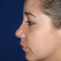 Rinoplastia después A