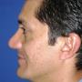 Rinoplastia después C