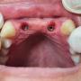 Caso clínico implantes zona anterior