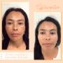 Tratamientos Faciales
