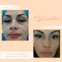Trata Manchas Y  Pecas con Cosmelan