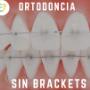 Ortodoncia Sin Brackets