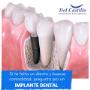 Implantes dentales.
