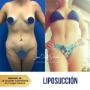 Liposucción