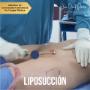 Liposucción