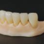 Coronas zirconio