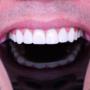 Diseño de sonrisa