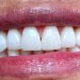 Diseño de sonrisa