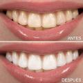 Blanqueamiento dental