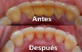 Limpieza dental