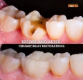 Ceramic Onlay Fillings