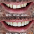 Ceramic Veneers
