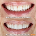 Composite veneers