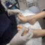 Deslaminado de uñas con hongo