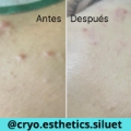 Limpieza facial (2)