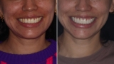 Smile makeover Colombia