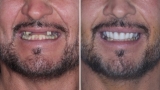 Smile restoration