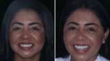 Dental implants in Colombia