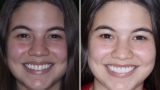 Affordable dental implants