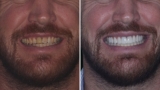Full mouth dental implants